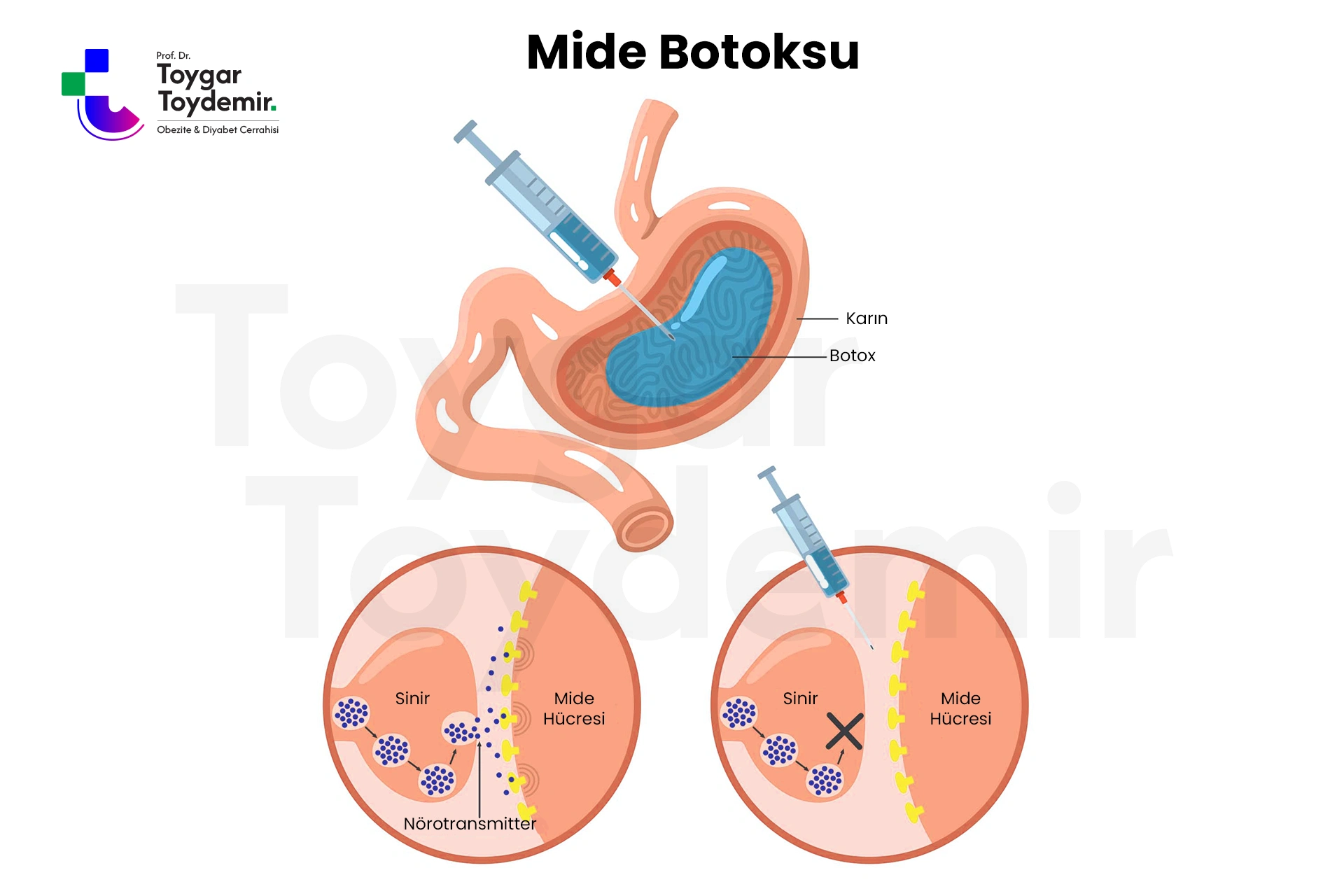 Mide botoksu uygulaması