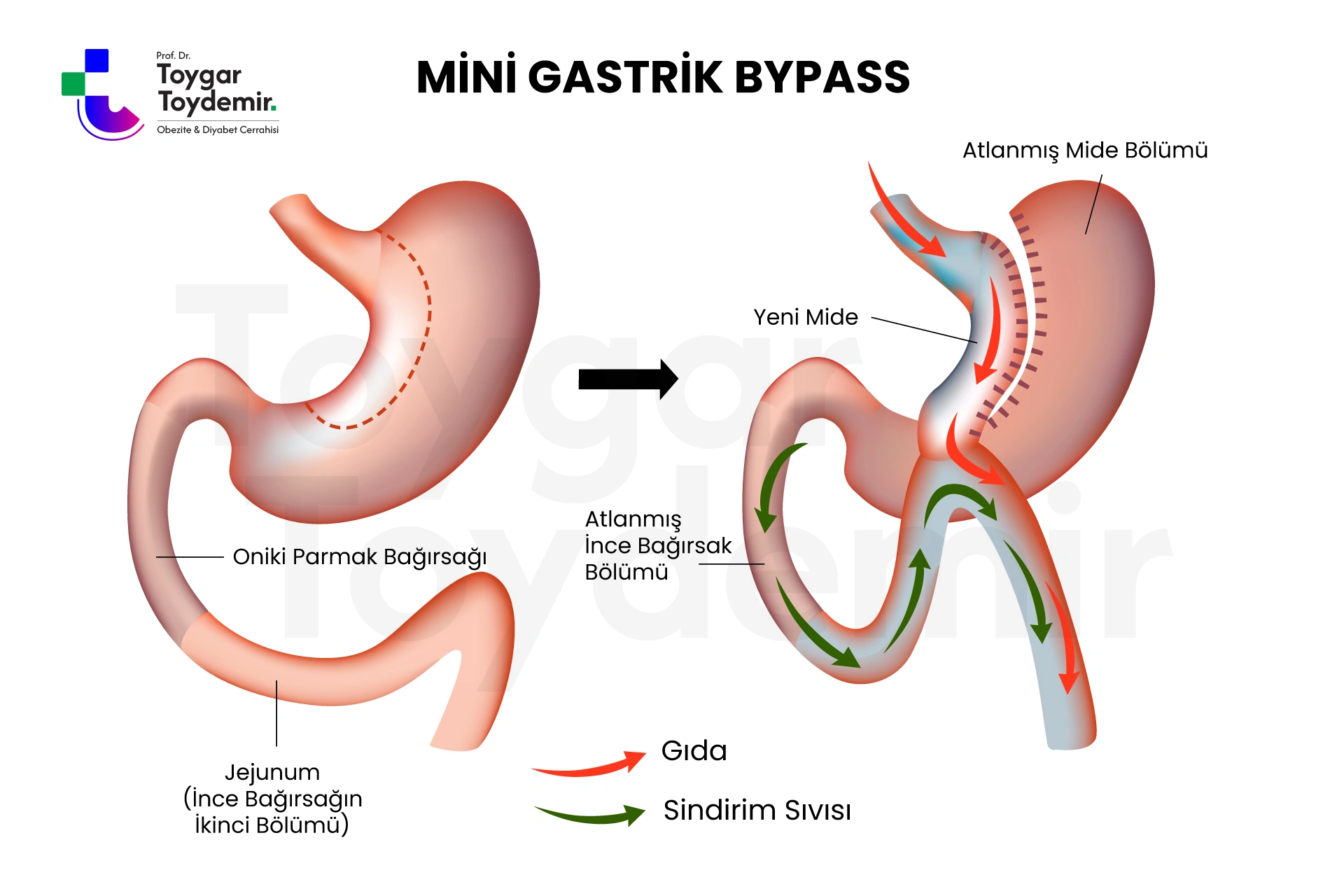 Mini gastrik bypass öncesi sonrası 