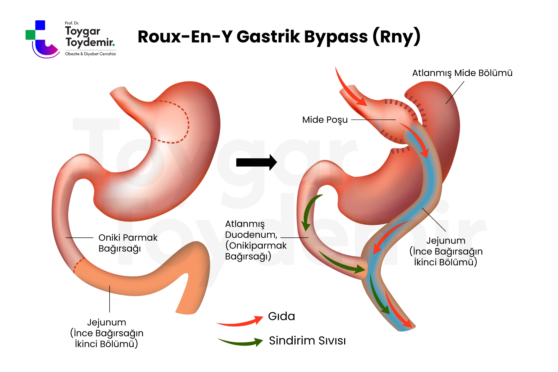 RNY Gastrik Bypass öncesi sonrası 