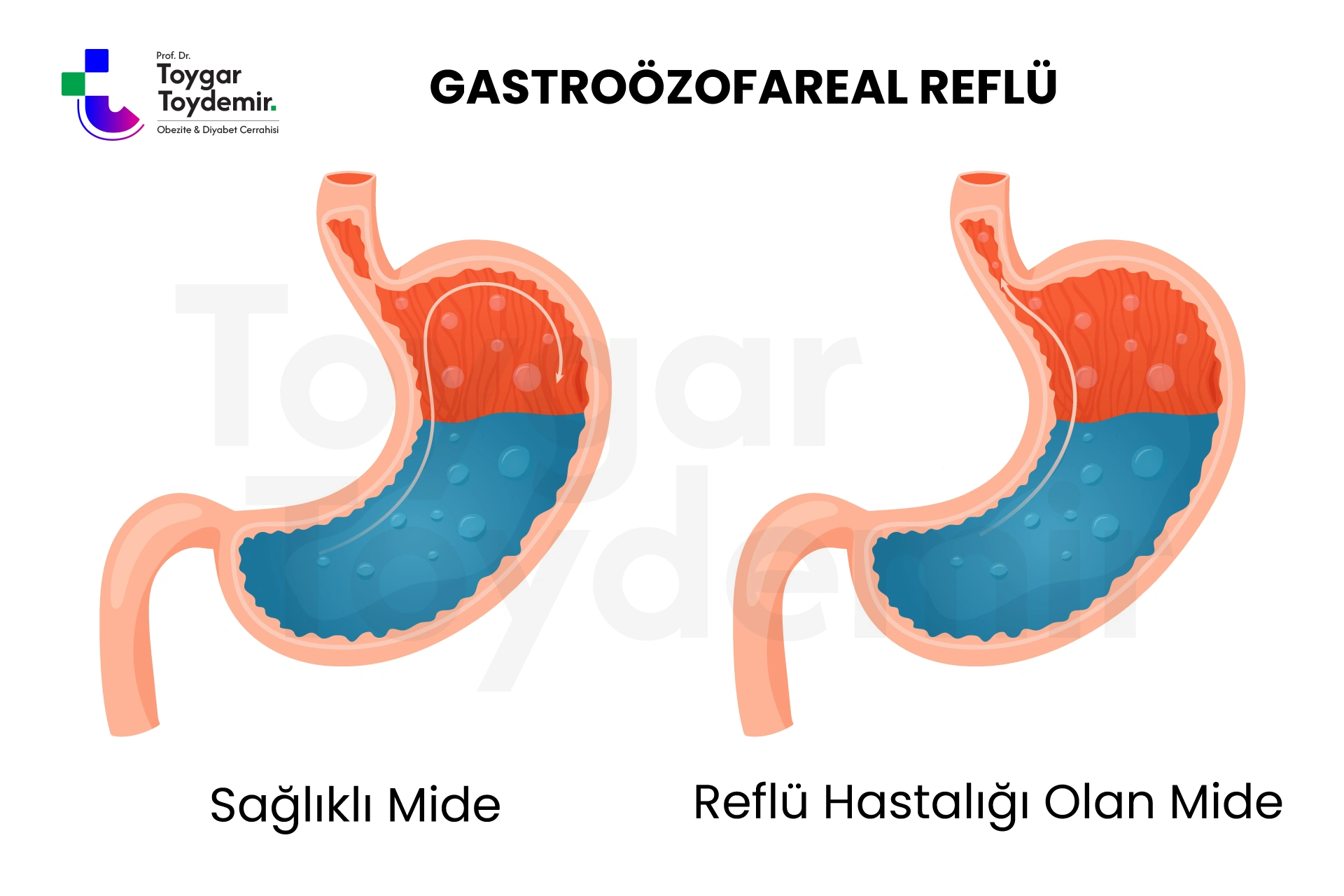 Reflü hastalığı olan mide