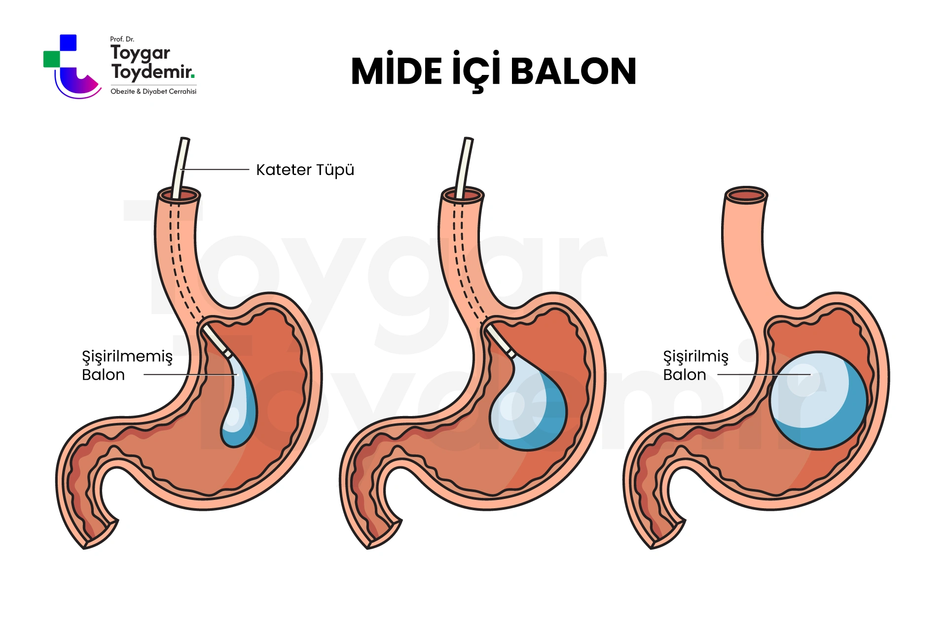 mide içine balon yerleştirilmesi